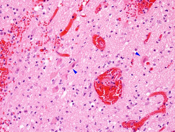 1C5 Infarct, hemorrhagic, Tonsillar Herniation (Case 1) N8 H&E 3 copy