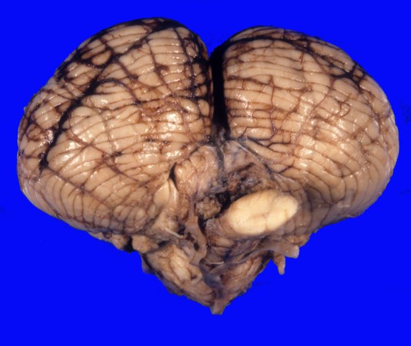 2A1 Hemorrhage, Tonsillar herniation (Case 2) 1