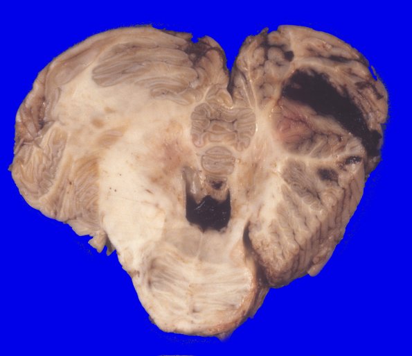 2A2 Hemorrhage, Tonsillar herniation (Case 2) 6