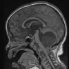 3A1 Astrocytoma, pilocytic, tonsillar herniation (Case 3) T1 2 - Copy