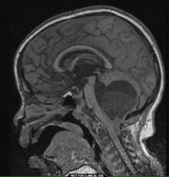 3A1 Astrocytoma, pilocytic, tonsillar herniation (Case 3) T1 2 - Copy