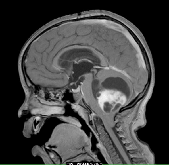 3A2 Astrocytoma, pilocytic, tonsillar herniation (Case 3) T1 W2 - Copy