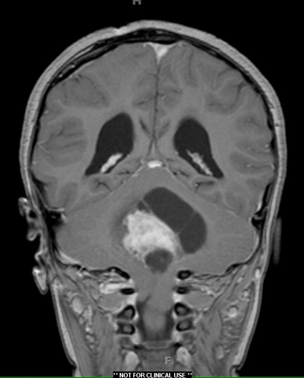 3A3 Astrocytoma, pilocytic, tonsillar herniation (Case 3) T1 W5 - Copy