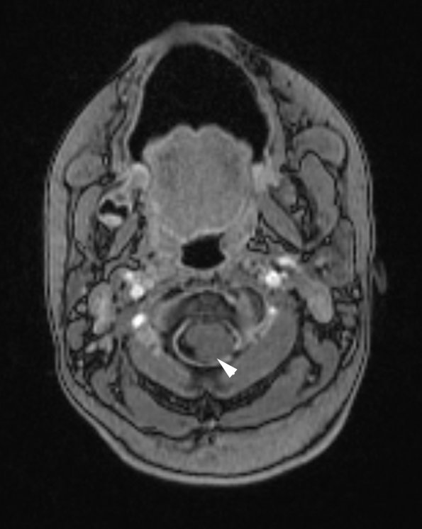 3A4 Astrocytoma, pilocytic, tonsillar herniation (Case 3) T1 W3 copy - Copy