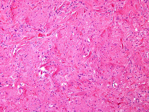 3B Astrocytoma, pilocytic (Case 3) H&E 1