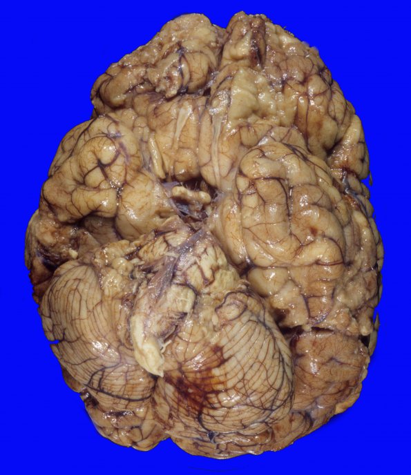 4A1 Erlichiosis, edema tonsillar and uncal herniation (Case 4) 2