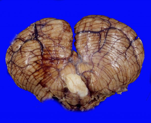 4A2 Erlichiosis, edema tonsillar and uncal herniation (Case 4) 3