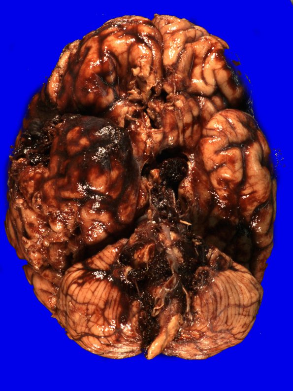 5A1 Herniation, tonsillar, GSW (Case 5) 5