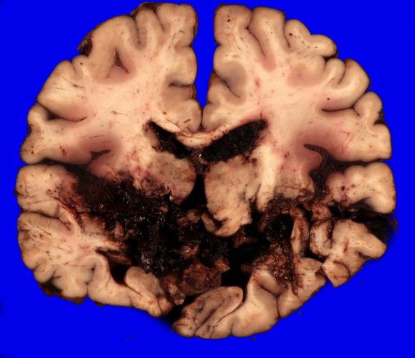 5A2 Herniation, tonsillar, GSW (Case 5) 18