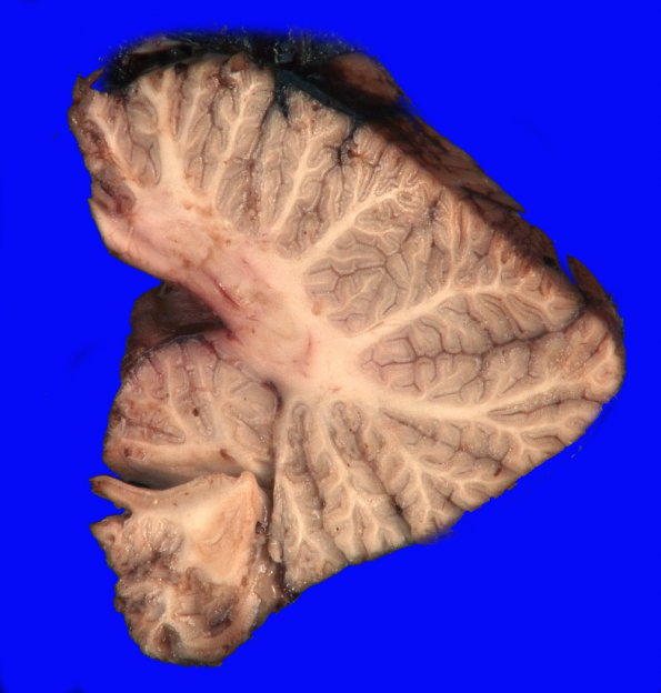 5A3 Herniation, tonsillar, GSW (Case 5) 11