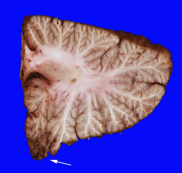 5A4 Herniation, tonsillar, GSW (Case 5) 14 copy