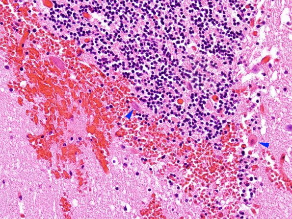 5B1 Herniation, tonsillar, GSW (Case 5) H&E 1 copy