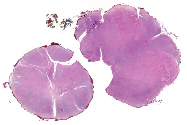 5B2 Herniation, tonsillar, GSW (Case 5) N8 whole mount