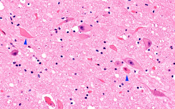 5B3 Herniation, tonsillar, GSW (Case 5) 11A copy