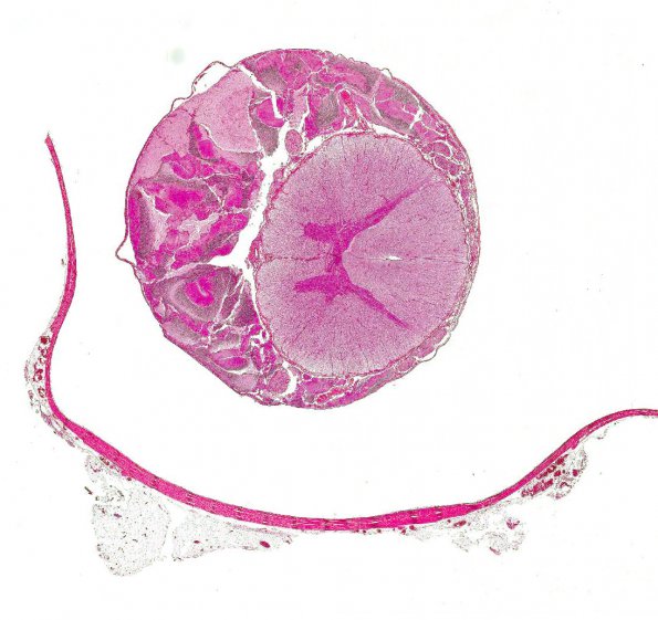 6A1 Herniation, tonsillar (AANP 1994, Case 10) H&E X0.5