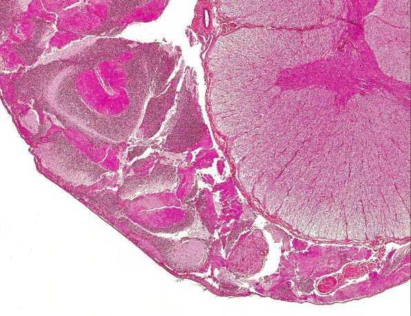 6A2 Herniation, tonsillar (AANP 1994, Case 10) H&E X2 1