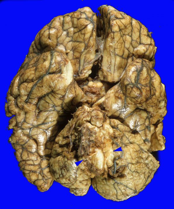 7A1 Herniation, uncal & tonsillar (Case 7) 1 copy