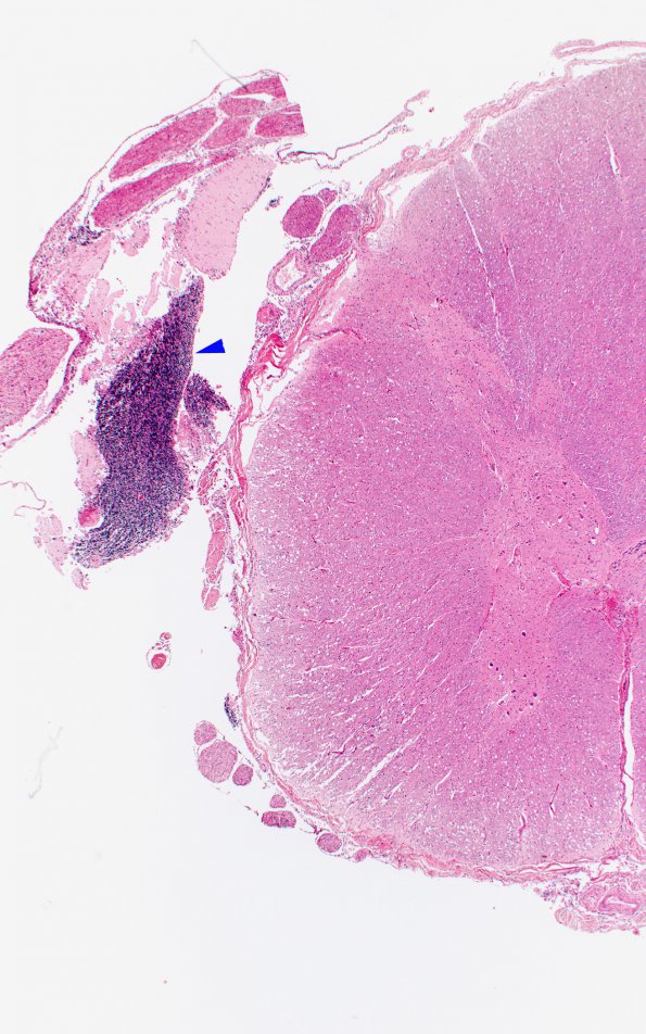 7B1 Herniation, uncal & tonsillar (Case 7) Thoracic Cord 2X copy