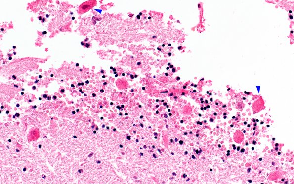 7B3 Herniation, uncal & tonsillar (Case 7) Thoracic Cord 40X 1 copy