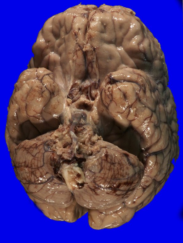 8A1 Herniation, tonsillar (Case 8) _1