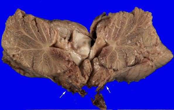 8A2 Herniation, tonsillar (Case 8) _2 copy