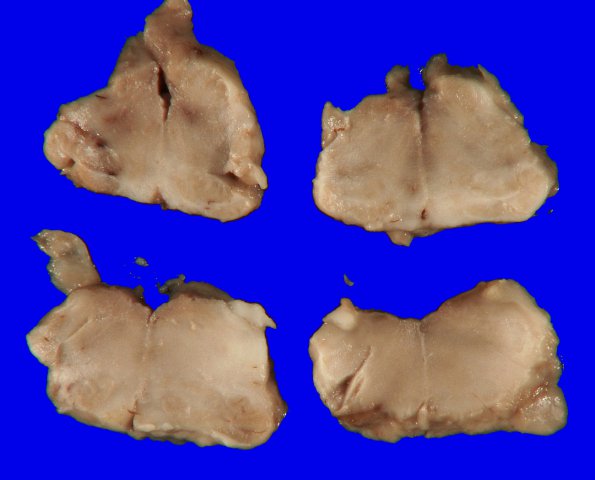 8A3 Herniation, tonsillar (Case 8) _3