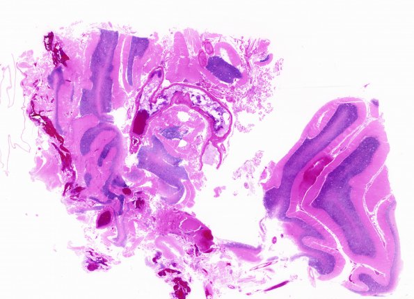 8B1 NK cell intravascular lymphoma (Case 8) N10  H&E WM