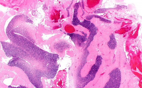 8B2 NK cell intravascular lymphoma (Case 8) N10  H&E 2X