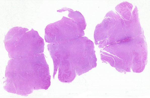 8C1 NK cell intravascular lymphoma (Case 8) N8  H&E WM