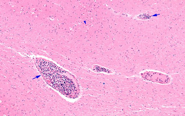 8C2 NK cell intravascular lymphoma (Case 8) N8  H&E 10X copy