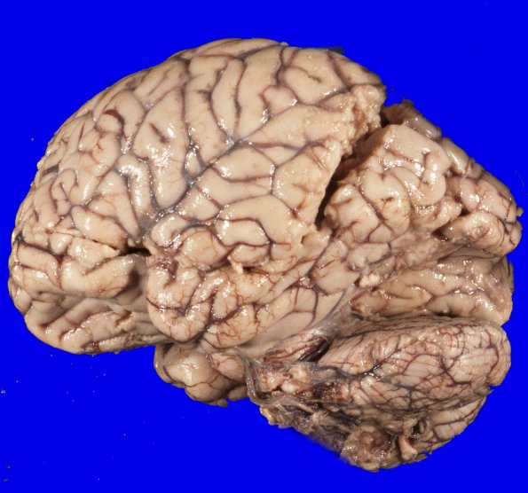 9A2 Herniation, tonsillar (Case 9) 2