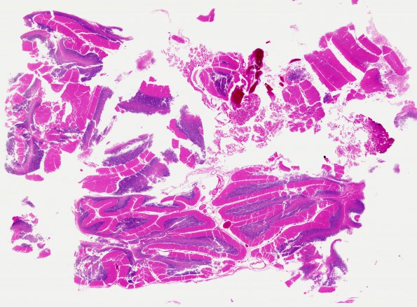 9B1 Herniation, tonsillar (Case 9) N20 WM