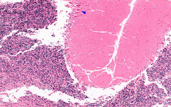 9B3 Herniation, tonsillar (Case 9) N20 10X copy