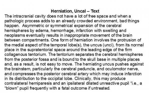 0A Herniation, uncal