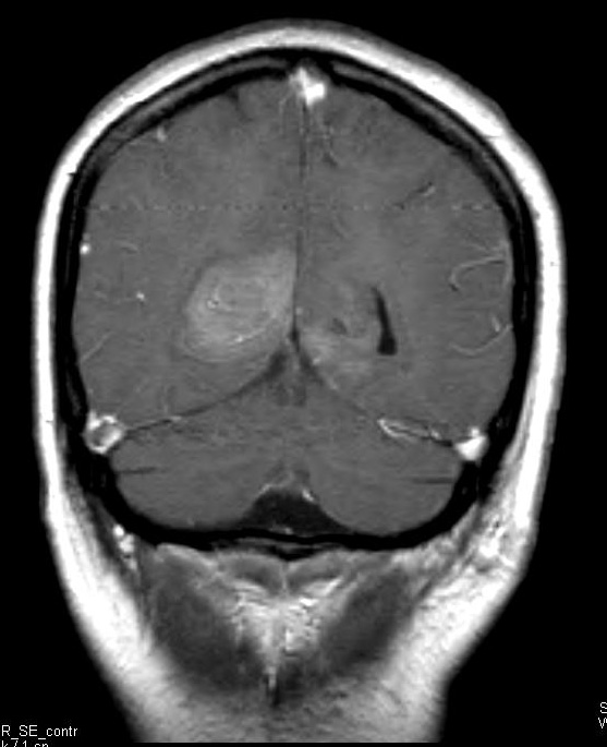 10A1 Herniation, Uncal, PCA (Case 10) T1 W 1 - Copy