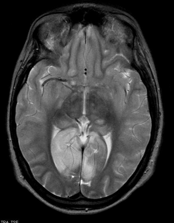 10A2 Herniation, Uncal PCA (Case 10) T2 1 - Copy