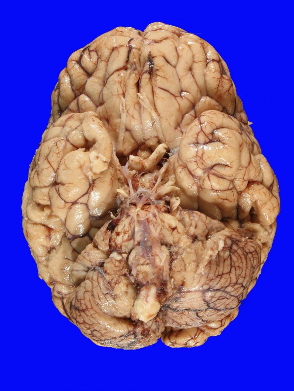 10B1 Herniation, Uncal PCA (Case 10) 1