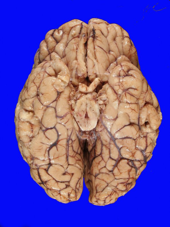 10B2 Herniation, Uncal PCA (Case 10) 2