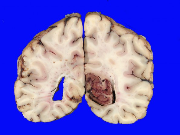 10B3 Herniation, Uncal PCA (Case 10) 3