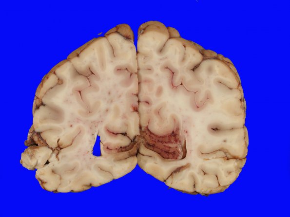 10B4 Herniation, Uncal PCA (Case 10) 4