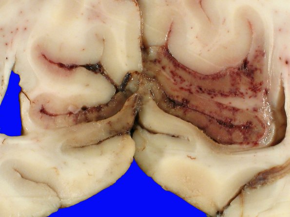 10B5 Herniation, Uncal PCA (Case 10) 6