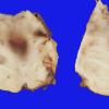 10B8 Herniation, Uncal PCA infarct (Case 10) 11