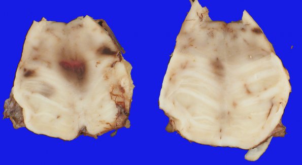 10B8 Herniation, Uncal PCA infarct (Case 10) 11