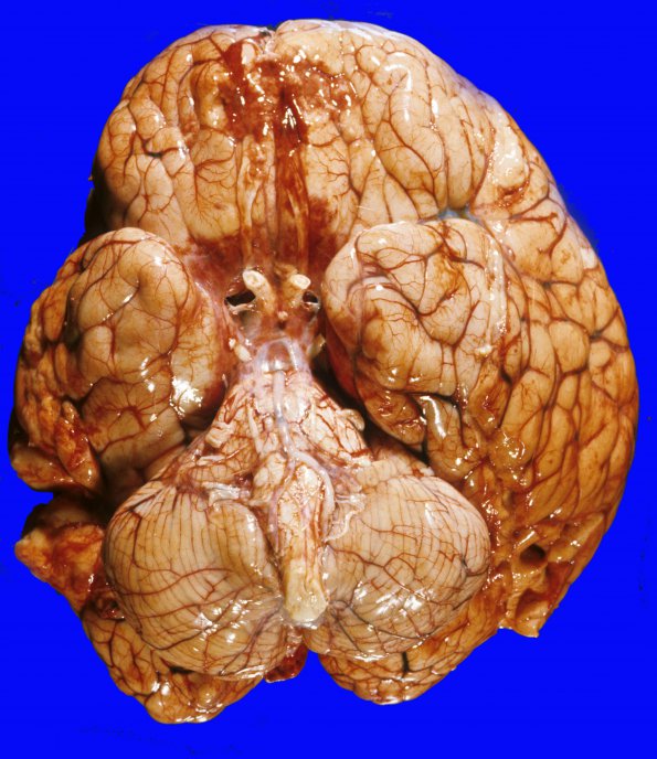 11A1 Herniation, uncal (PCA, Kernohan's (Case 11)