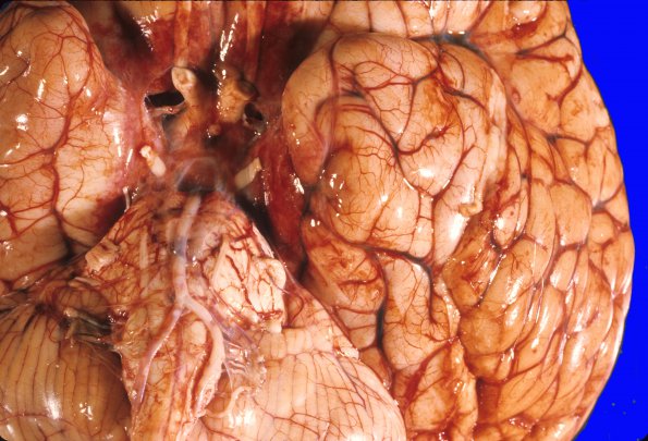 11A2 Herniation, uncal (Case 11) gross 1