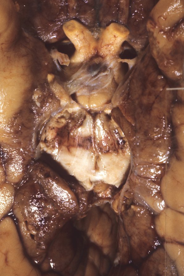 11A4 Herniation, uncal (PCA Kernohan's (Case 11) 6