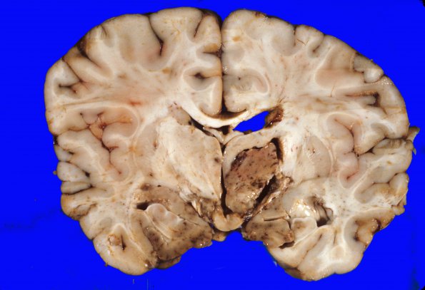 11A6 Herniation, uncal (PCA,Kernohan's (Case 11) 4