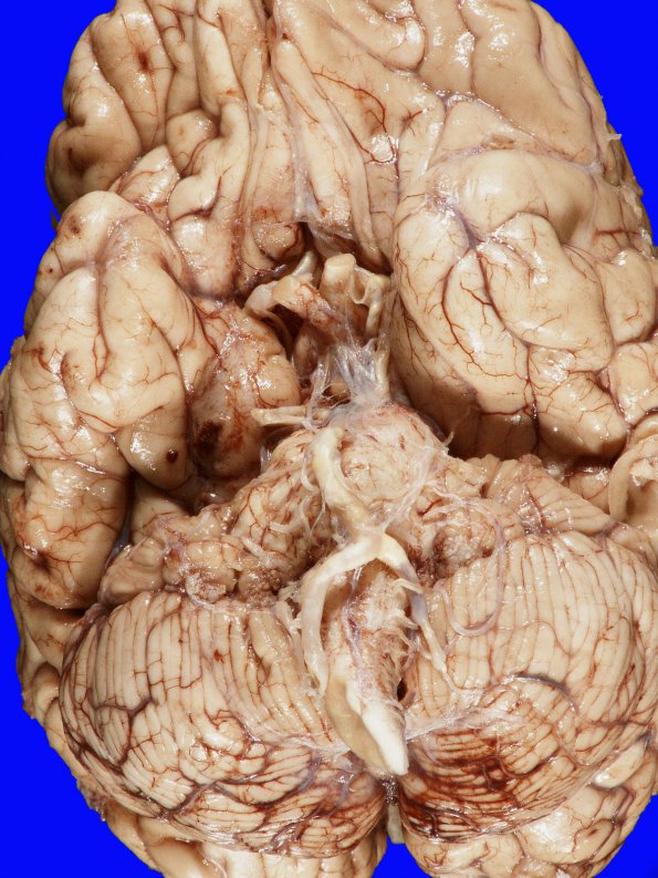 12B1 Herniation, Uncal (SDH, Case 12) Gross_2