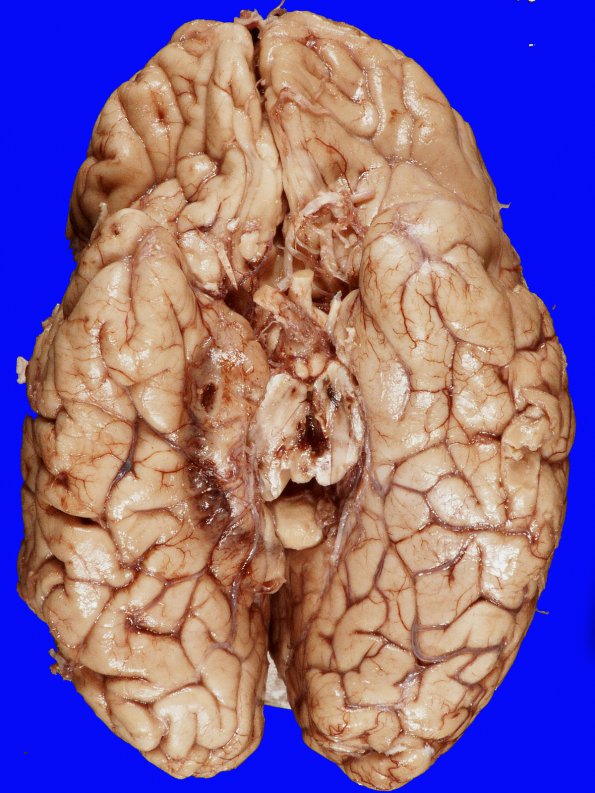 12B3 Herniation, Uncal (SDH, Case 12) Gross_5