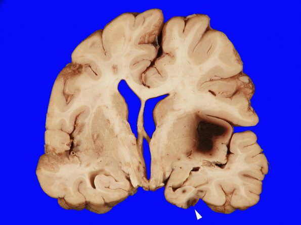 12B4 Herniation, Uncal (SDH, Case 12) Gross_9 copy